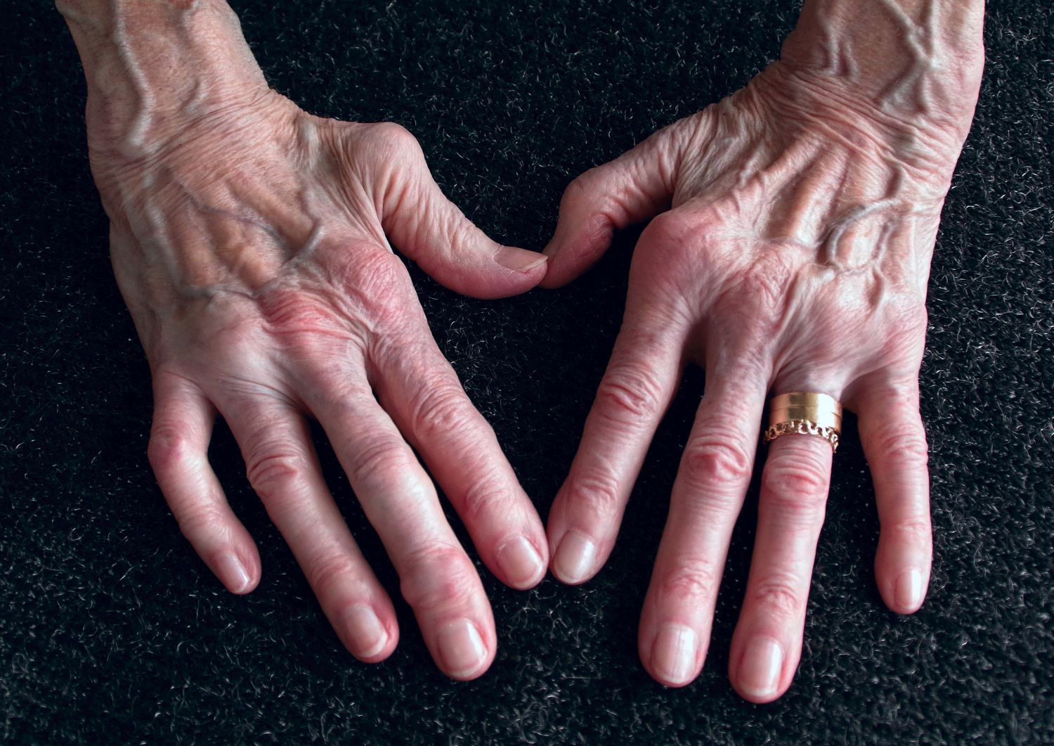 CBD-Rich Strains for Managing Pain from Arthritis 2